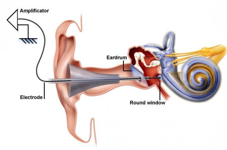 Hearing aids and market penetration